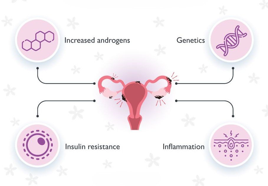 Causes PCOS