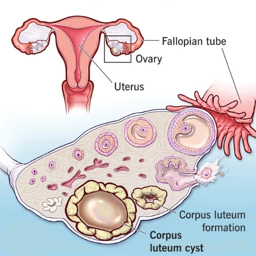 Corpus Luteum Cysts