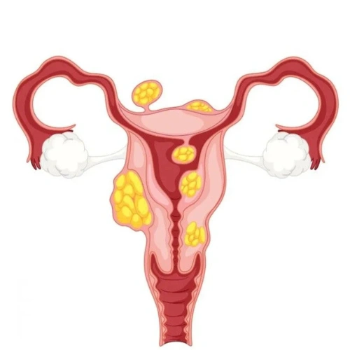 Dermoid Cysts