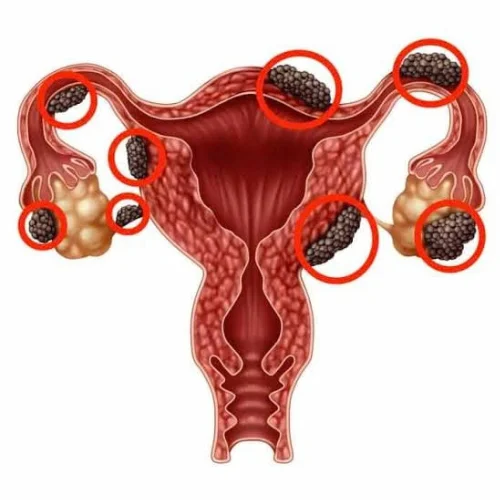 Endometriosis & Fertility