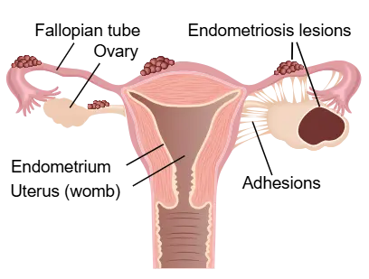Endometriosis