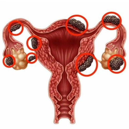 Endometriotic Cysts