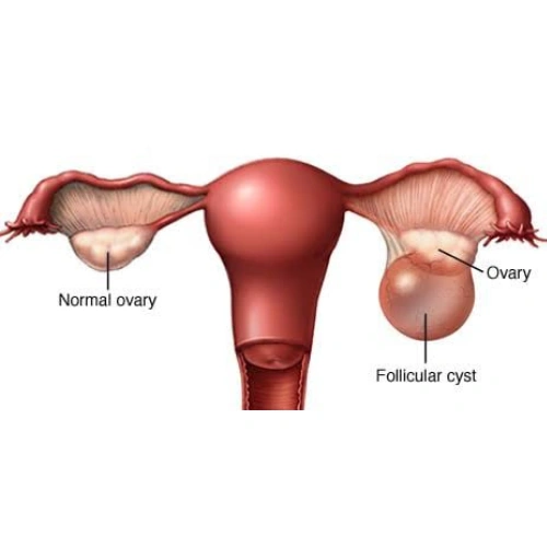 Follicular Cysts