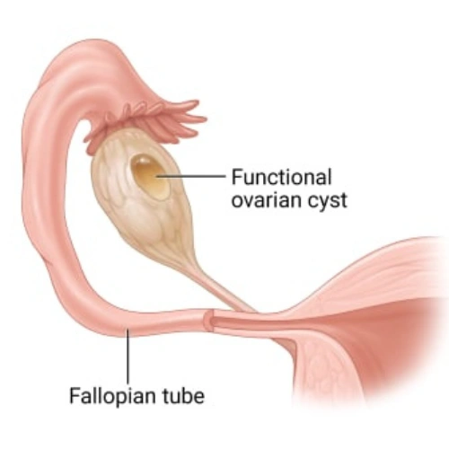 Functional Cysts
