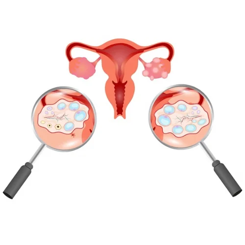 Management of PCOS & Hormonal Conditions
