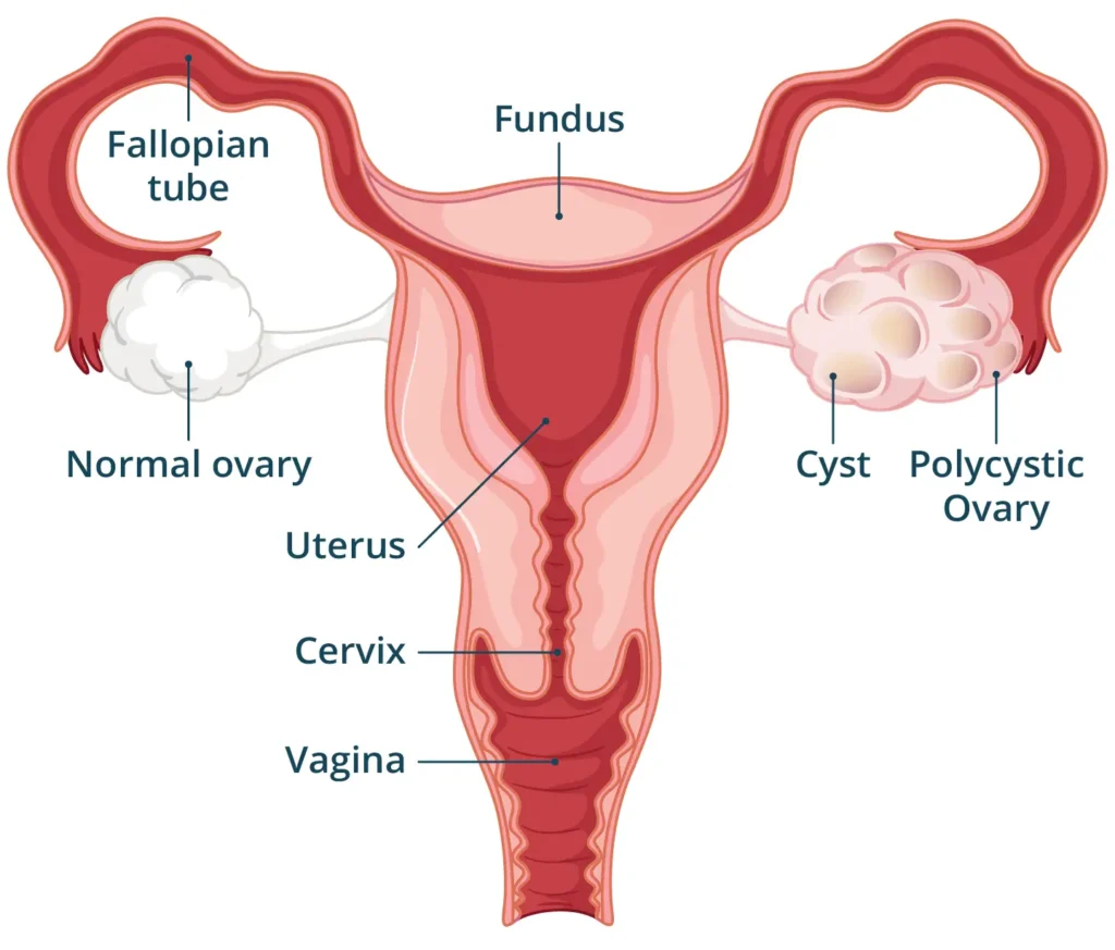 PCOS PCOD