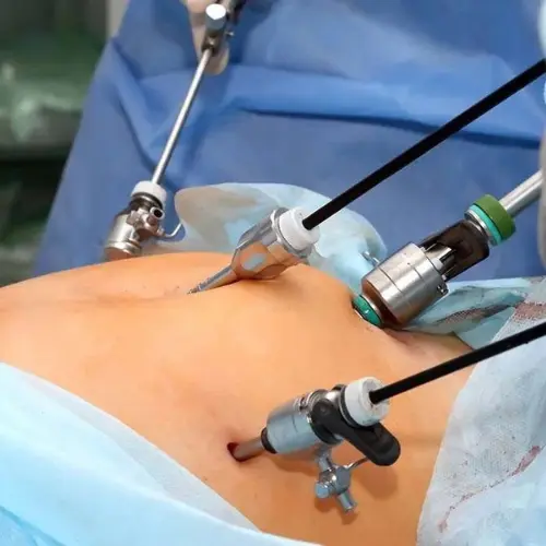 Laparoscopic Surgery